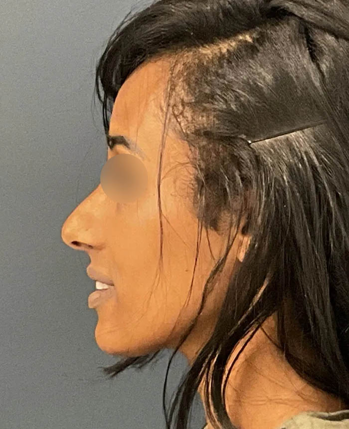 Rhinoplasty case #12940