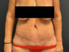 After Weight Loss case #13259