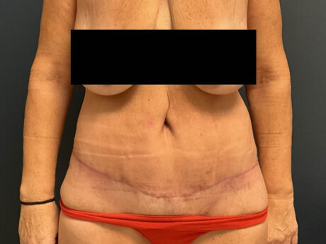 After Weight Loss case #13259
