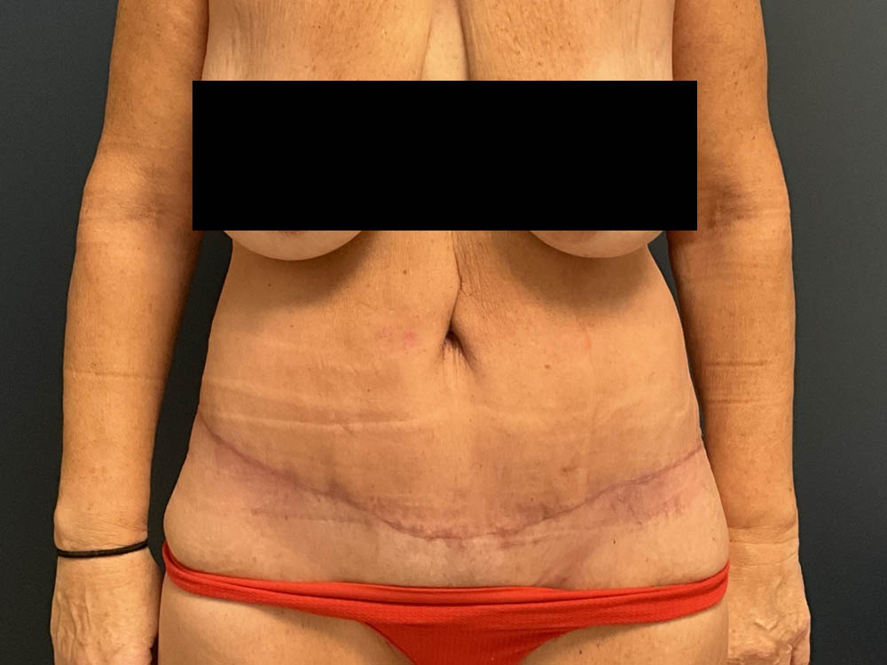 After Weight Loss case #13259