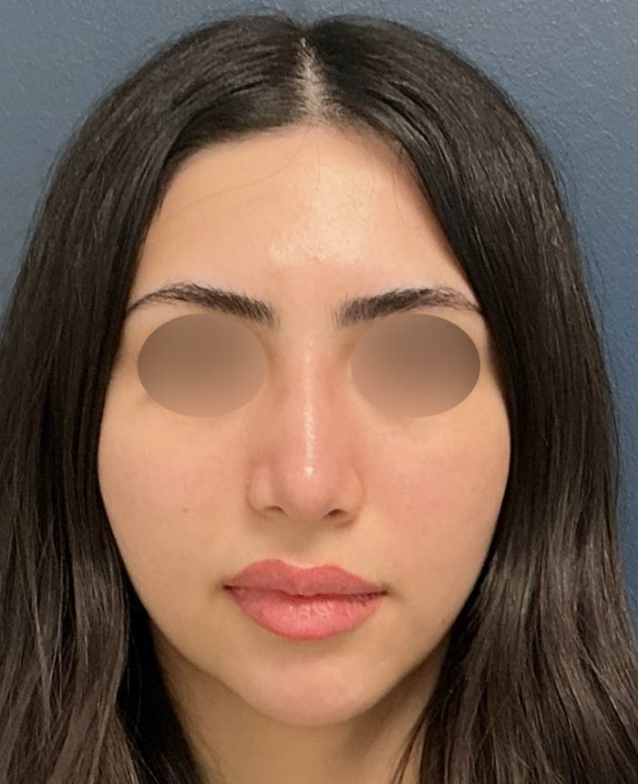Rhinoplasty case #13109