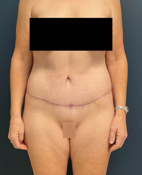Lower Body Lift case #13252
