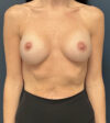 Breast Augmentation case #12999