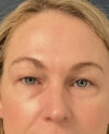 Eyelid Surgery case #12923