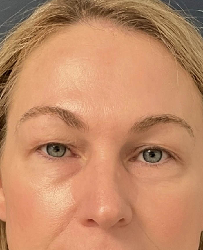 Eyelid Surgery case #12923
