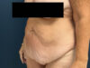 After Weight Loss case #13259