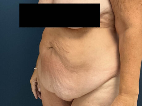 After Weight Loss case #13259
