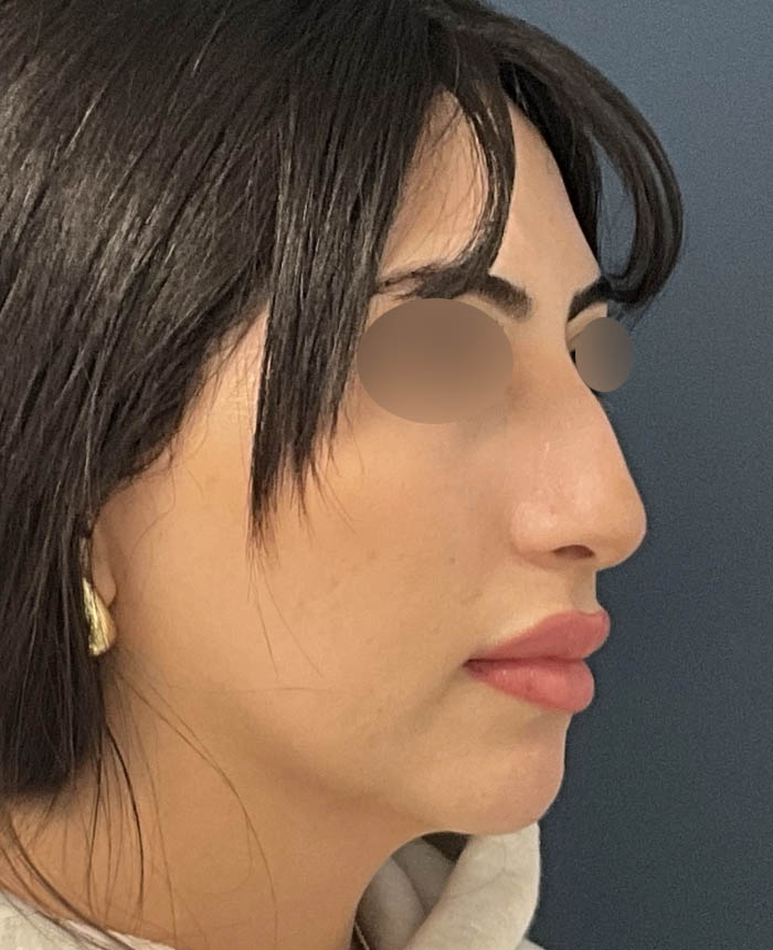 Rhinoplasty case #13109