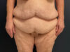 After Weight Loss case #13484