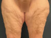 After Weight Loss case #13484