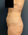 Lower Body Lift case #13252
