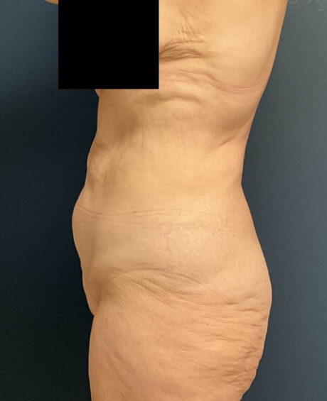 Lower Body Lift case #13252