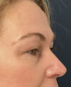 Eyelid Surgery case #12923