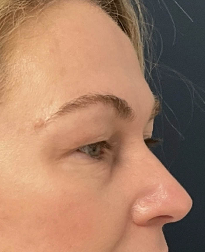 Eyelid Surgery case #12923
