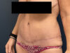 After Weight Loss case #13259