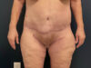 After Weight Loss case #13484