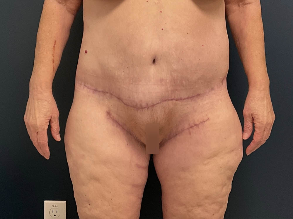 After Weight Loss case #13484
