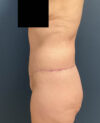 Lower Body Lift case #13252