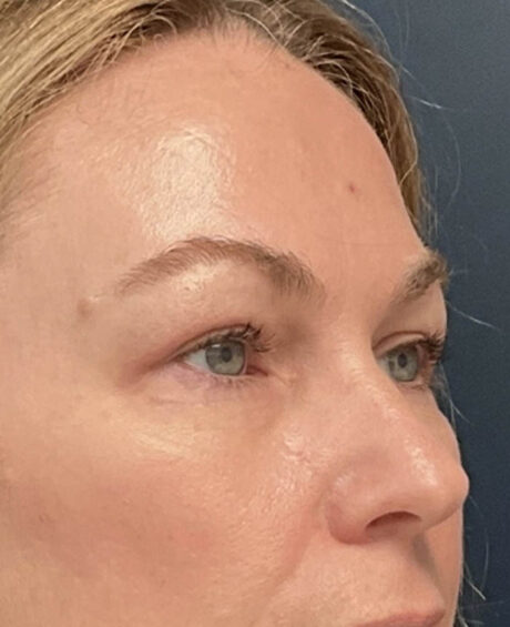 Eyelid Surgery case #12923