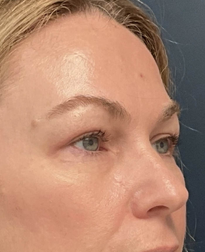 Eyelid Surgery case #12923