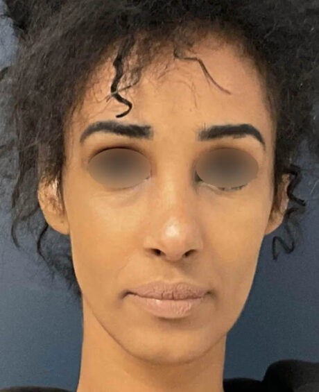 Rhinoplasty case #12940