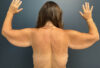 After Weight Loss case #13264