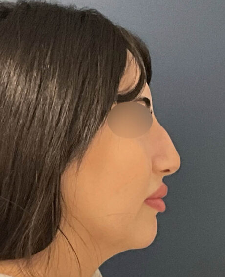Rhinoplasty case #13109
