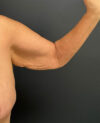 Thigh, Buttock, & Arm Lift case #13478