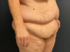 After Weight Loss case #13484