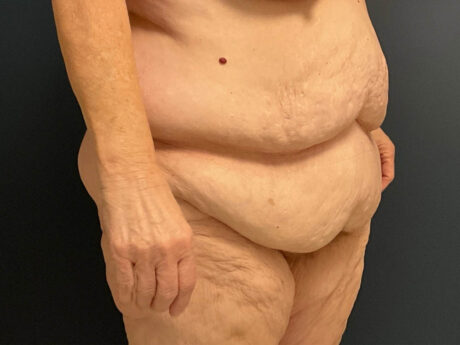 After Weight Loss case #13484