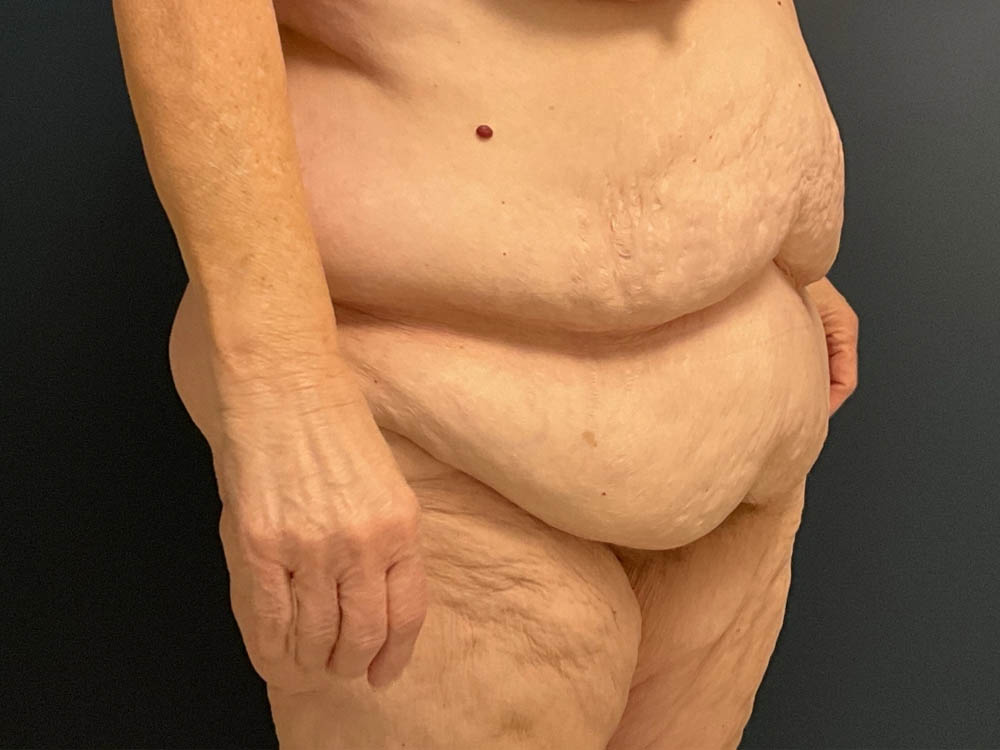After Weight Loss case #13484