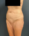 Lower Body Lift case #13252