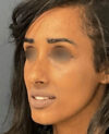 Rhinoplasty case #12940