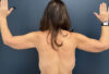 After Weight Loss case #13264