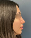 Rhinoplasty case #13109