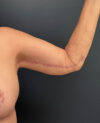 Thigh, Buttock, & Arm Lift case #13478