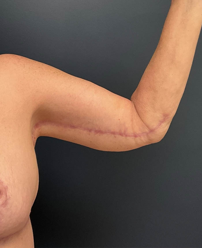 Thigh, Buttock, & Arm Lift case #13478