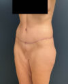 Lower Body Lift case #13252