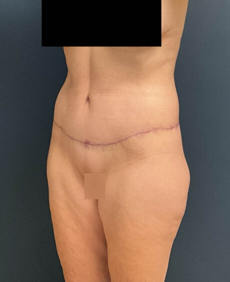 Lower Body Lift case #13252