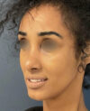 Rhinoplasty case #12940