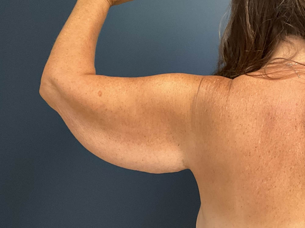 Arm Lift case #13264