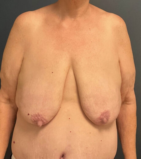 Breast Lift case #13489