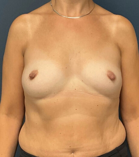 Breast Augmentation case #13189