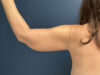 After Weight Loss case #13264