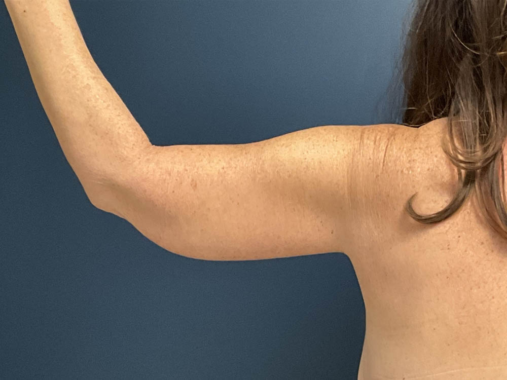 Arm Lift case #13264
