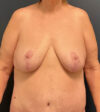 Breast Lift case #13489