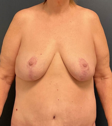 Breast Lift case #13489