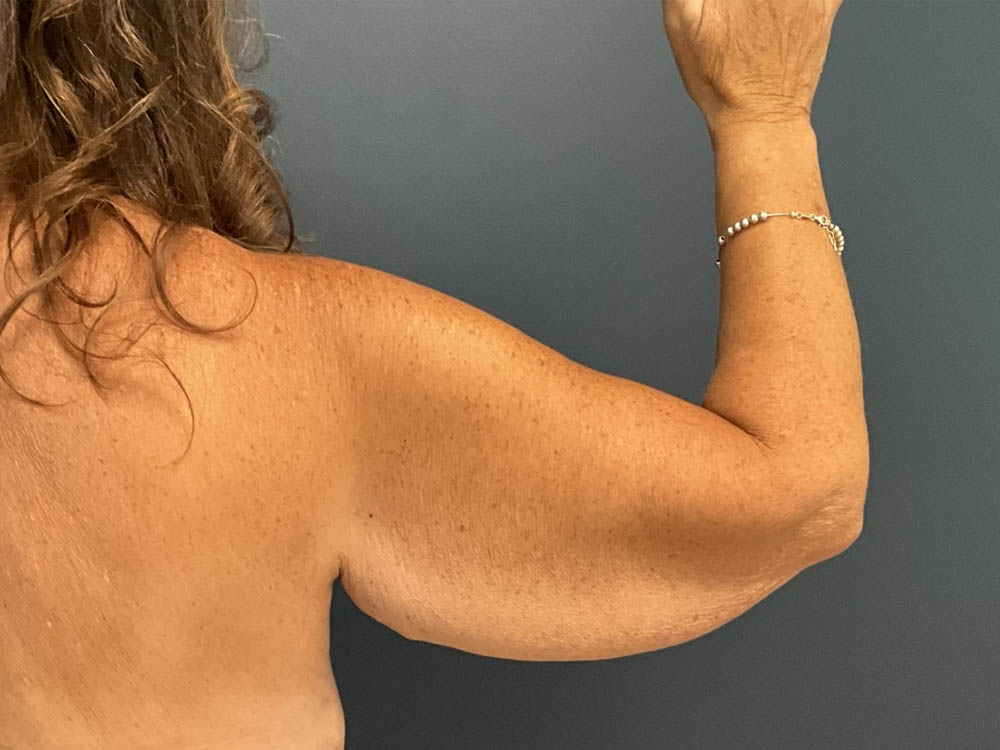 Arm Lift case #13264