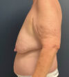 Breast Lift case #13489