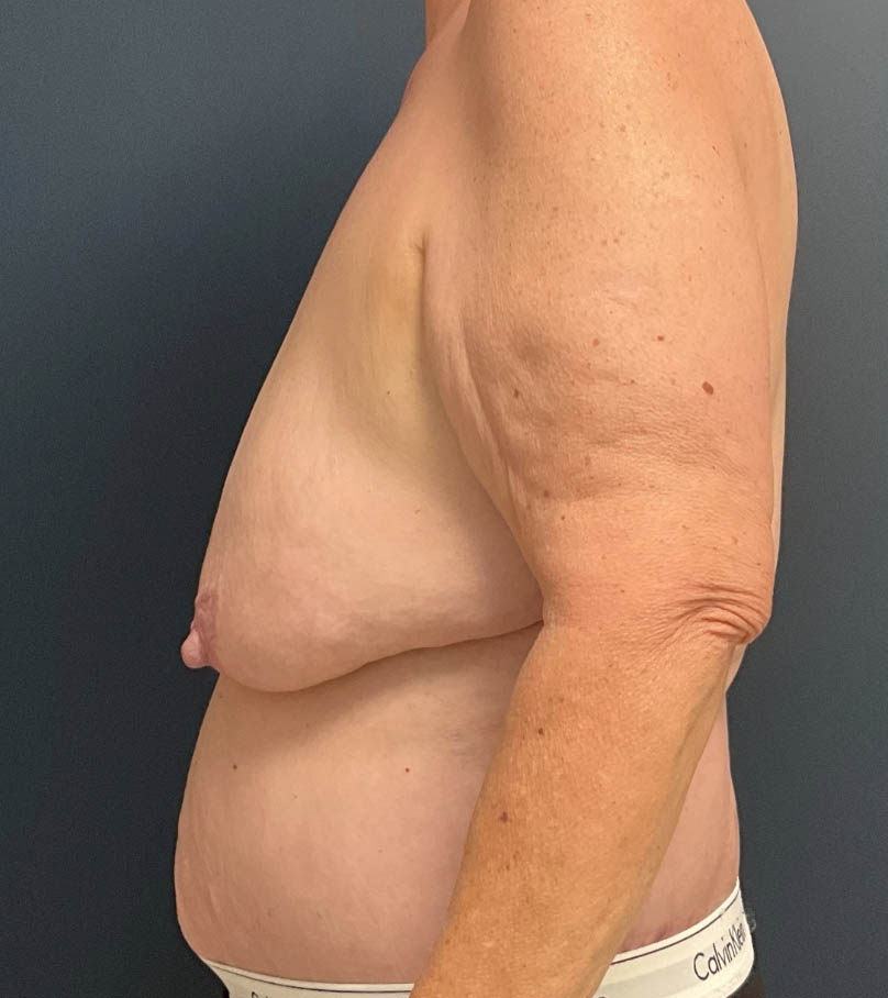 Breast Lift case #13489